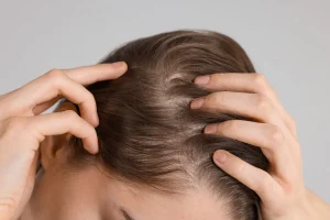 STUDIU GLOBAL: Un medicament pentru artrită a refăcut complet podoaba capilară la 1 din 5 pacienți cu alopecie severă